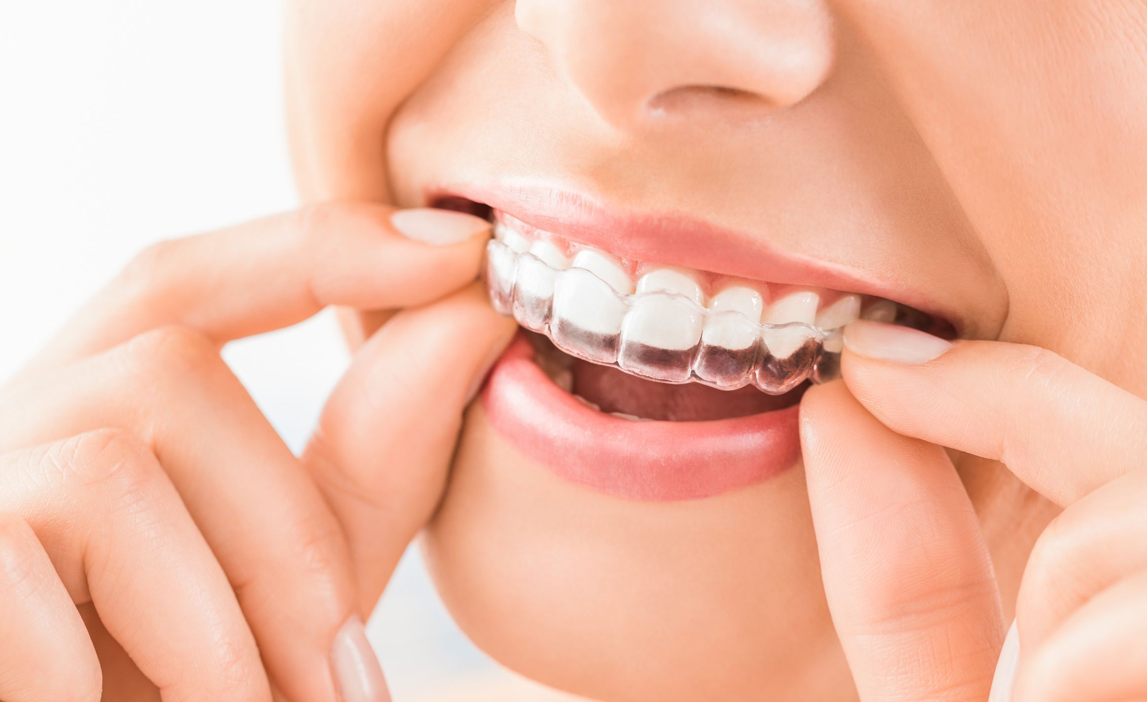 Invisalign Delray Beach, FL